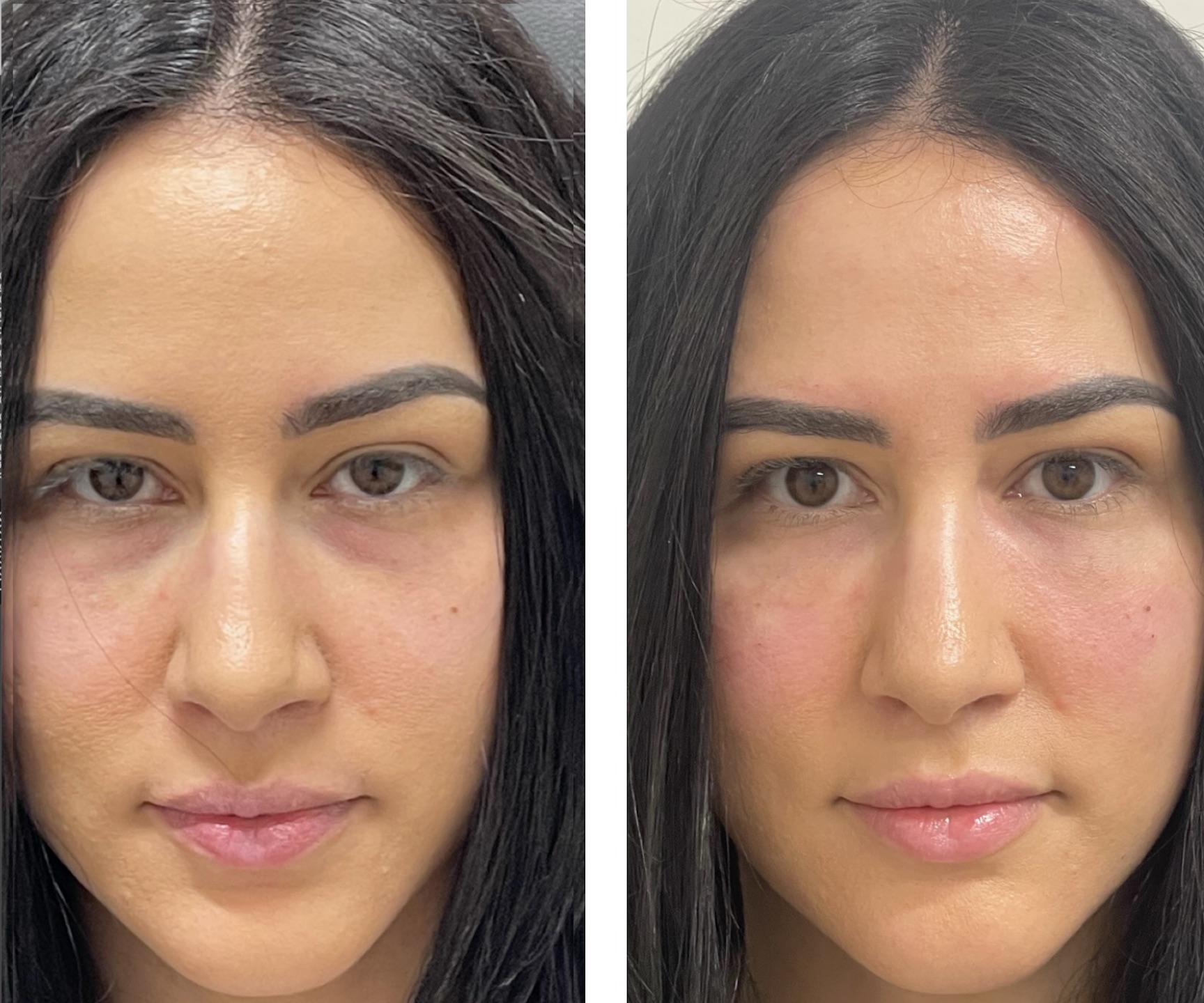 Before and After PRF Under Eye Tear Trough Injections from Erica Bedsted at Refyned Aesthetics Medical Spa in Fresno 